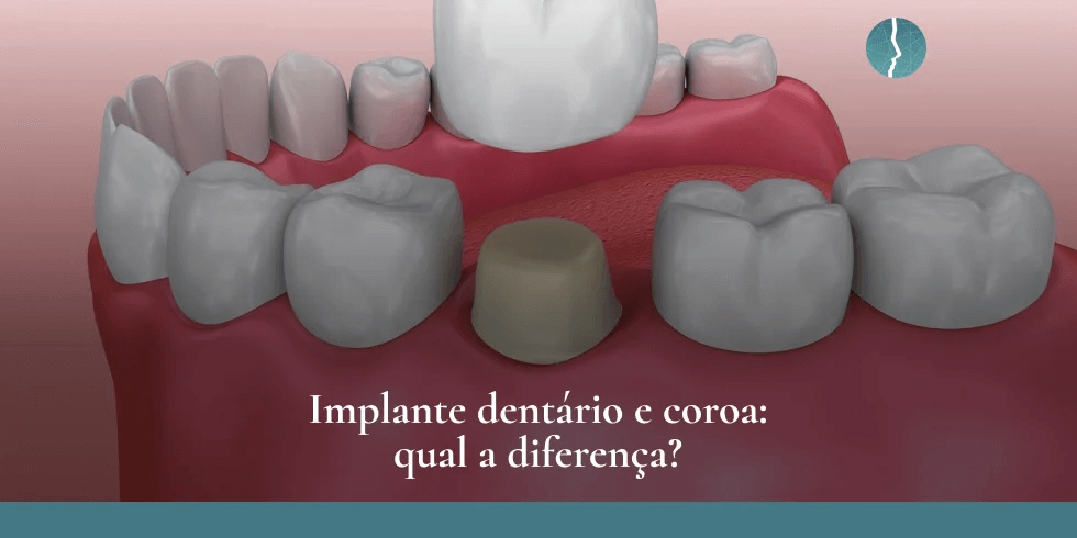 Implante dentário e coroa: Qual a diferença?