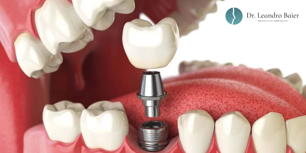 Implante dentário e coroa: Qual a diferença?
