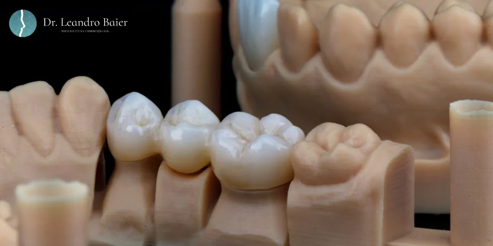 Implante dentário e coroa: Qual a diferença?
