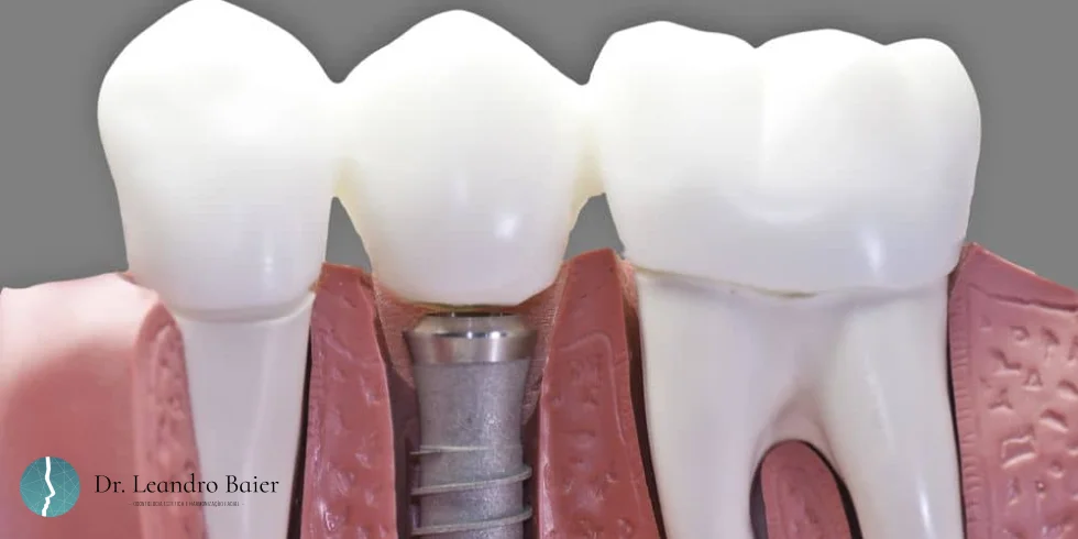 Implante dentário e coroa: Qual a diferença?
