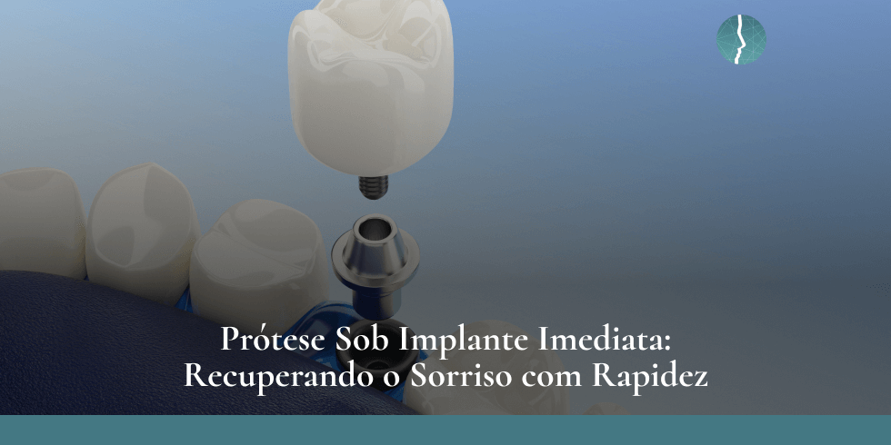 Prótese Sob Implante Imediata Recuperando o Sorriso com Rapidez