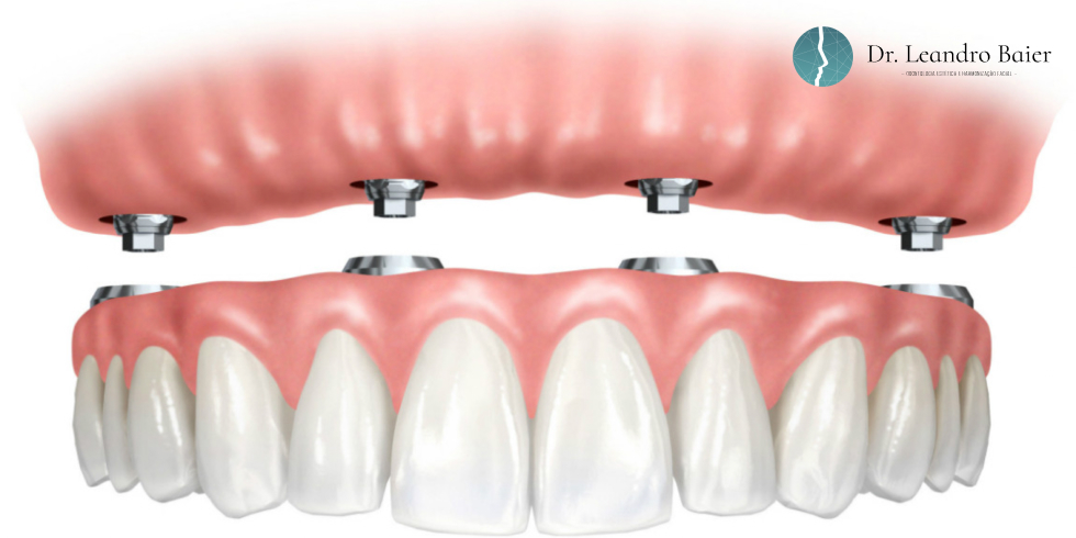 Dr. Leandro Baier | Clínica de Odontologia Estética em Blumenau, SC Prótese Sob Implante Imediata Recuperando o Sorriso com Rapidez