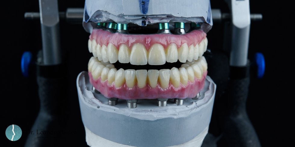 Dr. Leandro Baier | Clínica de Odontologia Estética em Blumenau, SC Prótese Sob Implante Imediata Recuperando o Sorriso com Rapidez