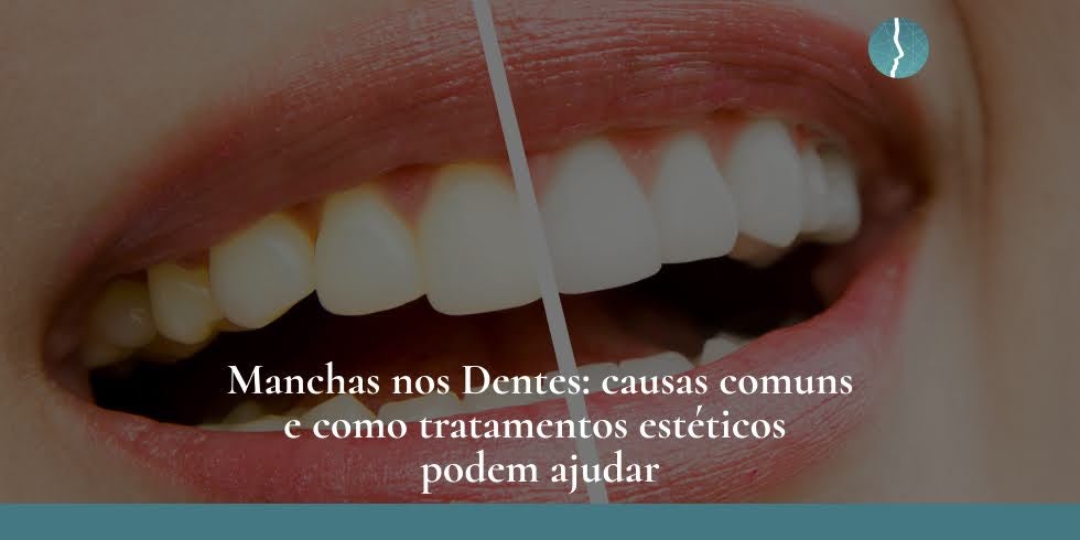 Manchas nos dentes: causas comuns e como tratamentos estéticos podem ajudar