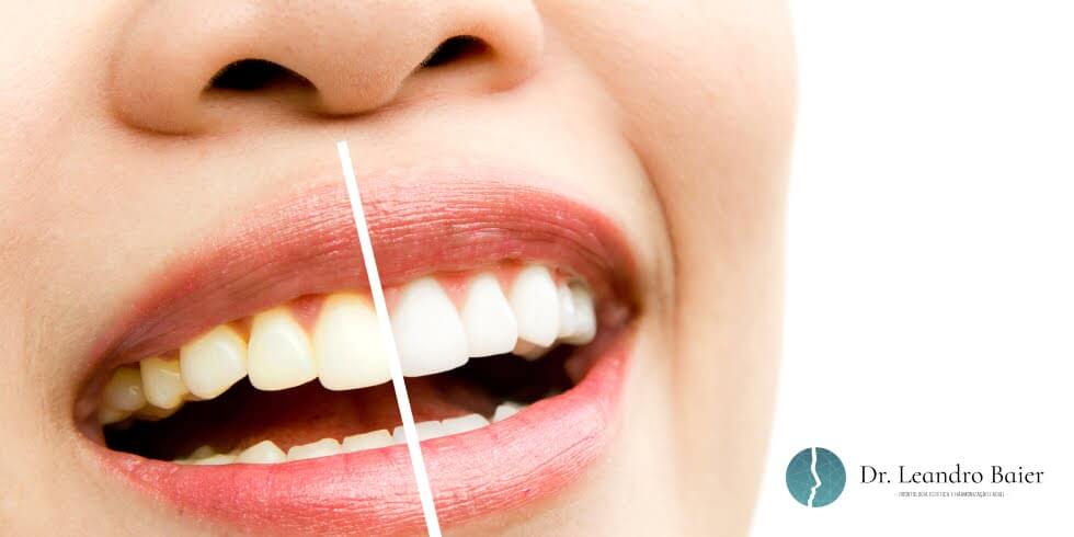 Dr. Leandro Baier | Clínica de Odontologia Estética em Blumenau, SC Manchas nos dentes: causas comuns e como tratamentos estéticos podem ajudar