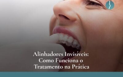 Alinhadores Invisíveis: Como Funciona o Tratamento na Prática
