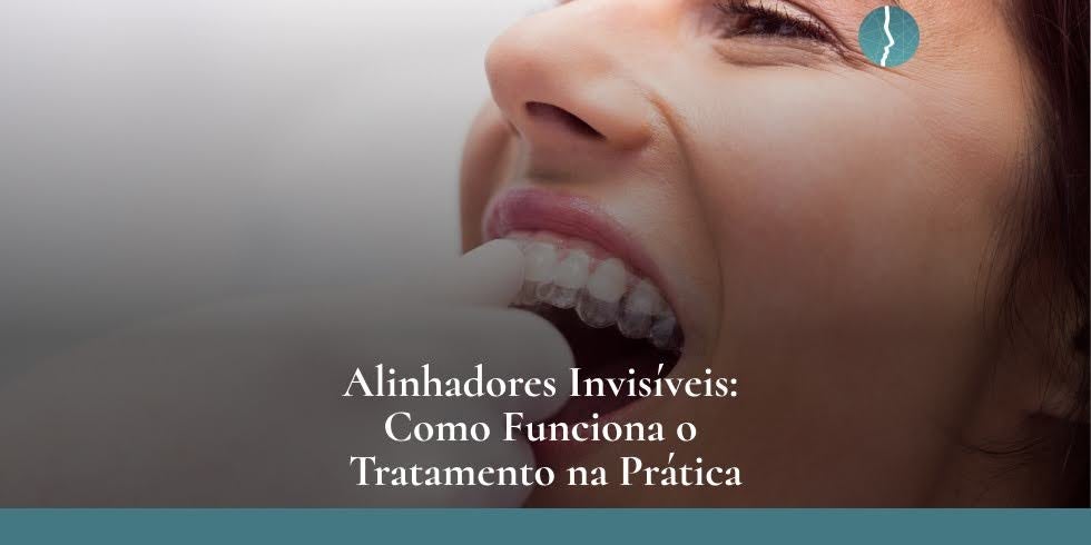 Alinhadores Invisíveis: Como Funciona o Tratamento na Prática