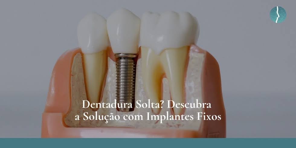Dentadura Solta? Descubra a Solução com Implantes Fixos