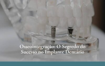 Osseointegração: O Segredo do Sucesso no Implante Dentário
