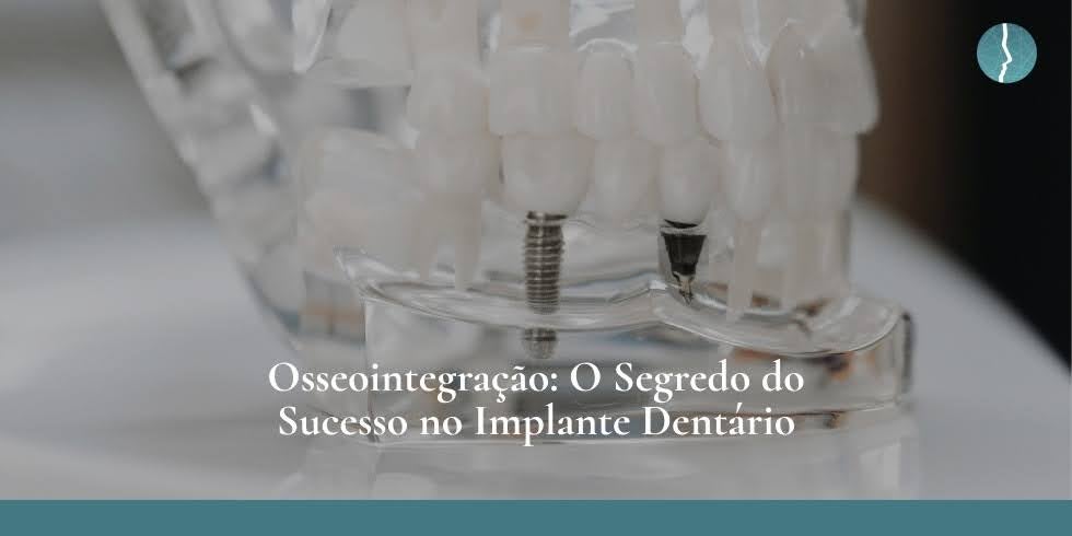 Osseointegração: O Segredo do Sucesso no Implante Dentário