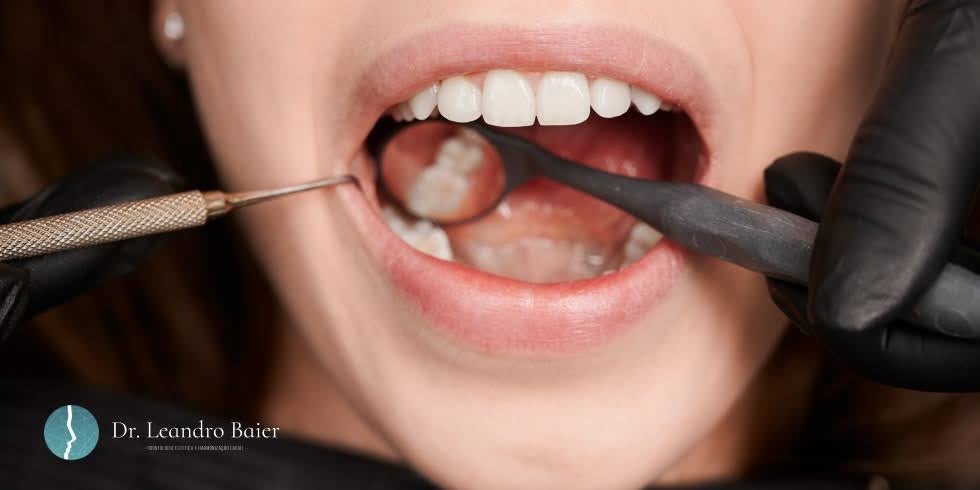 Dr. Leandro Baier | Clínica de Odontologia Estética em Blumenau, SC Dente Perdido Sem Reposição: Por Que Não Esperar Demais