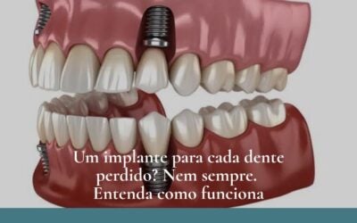 Dr. Leandro Baier | Clínica de Odontologia Estética em Blumenau, SC Implante Dentário em Blumenau: Um Implante para Cada Dente?