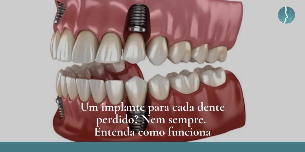 Implante Dentário em Blumenau: Um Implante para Cada Dente?