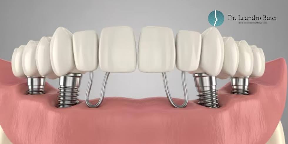 Implante Dentário em Blumenau: Um Implante para Cada Dente?
