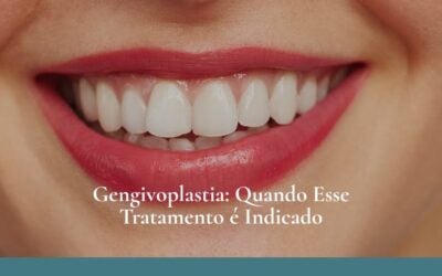 Dr. Leandro Baier | Clínica de Odontologia Estética em Blumenau, SC Gengivoplastia em Blumenau: Quando Esse Tratamento é Indicado