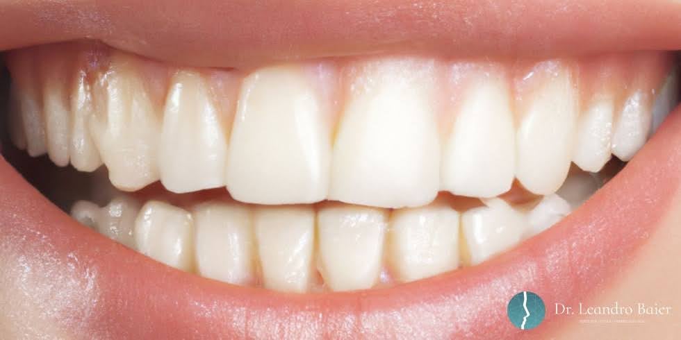 Dr. Leandro Baier | Clínica de Odontologia Estética em Blumenau, SC Dr. Leandro Baier | Clínica de Odontologia Estética em Blumenau, SC